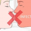 Prevención de un herpes labial