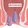 Uso de hamamelis para tratar las hemorroides