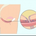 Hacer ejercicios de kegel