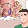 Cómo remediar las hemorroides dolorosas