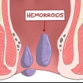 Uso de hamamelis para tratar las hemorroides