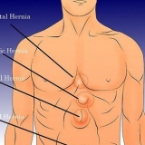 Comprobar si sufres de una hernia