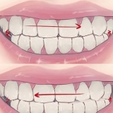 Deja de rechinar los dientes mientras duermes