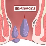 Uso de hamamelis para tratar las hemorroides