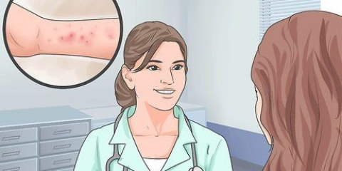 Aliviar los síntomas de la dermatitis espongiótica