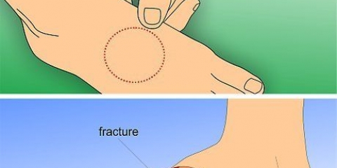 Tratamiento de una fractura por estrés en el pie