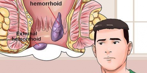 Cómo remediar las hemorroides dolorosas